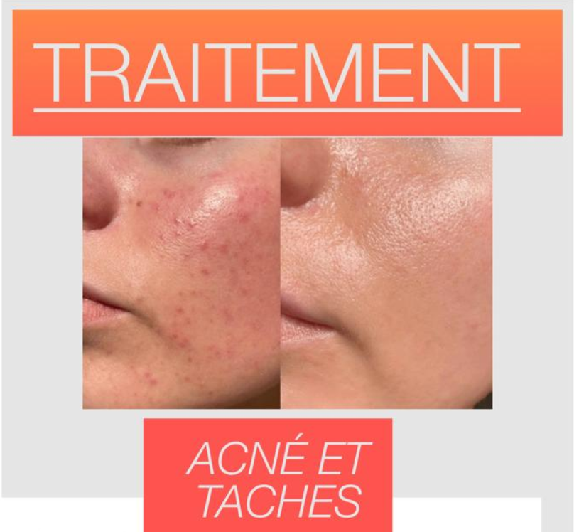 Avant/Après traitement acné